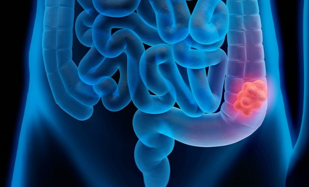 Más de 100.000 personas en edad de riesgo no han participado en el cribado de cáncer colorrectal en Bizkaia