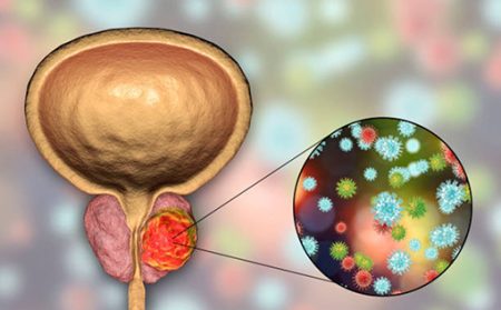 cancer prostata